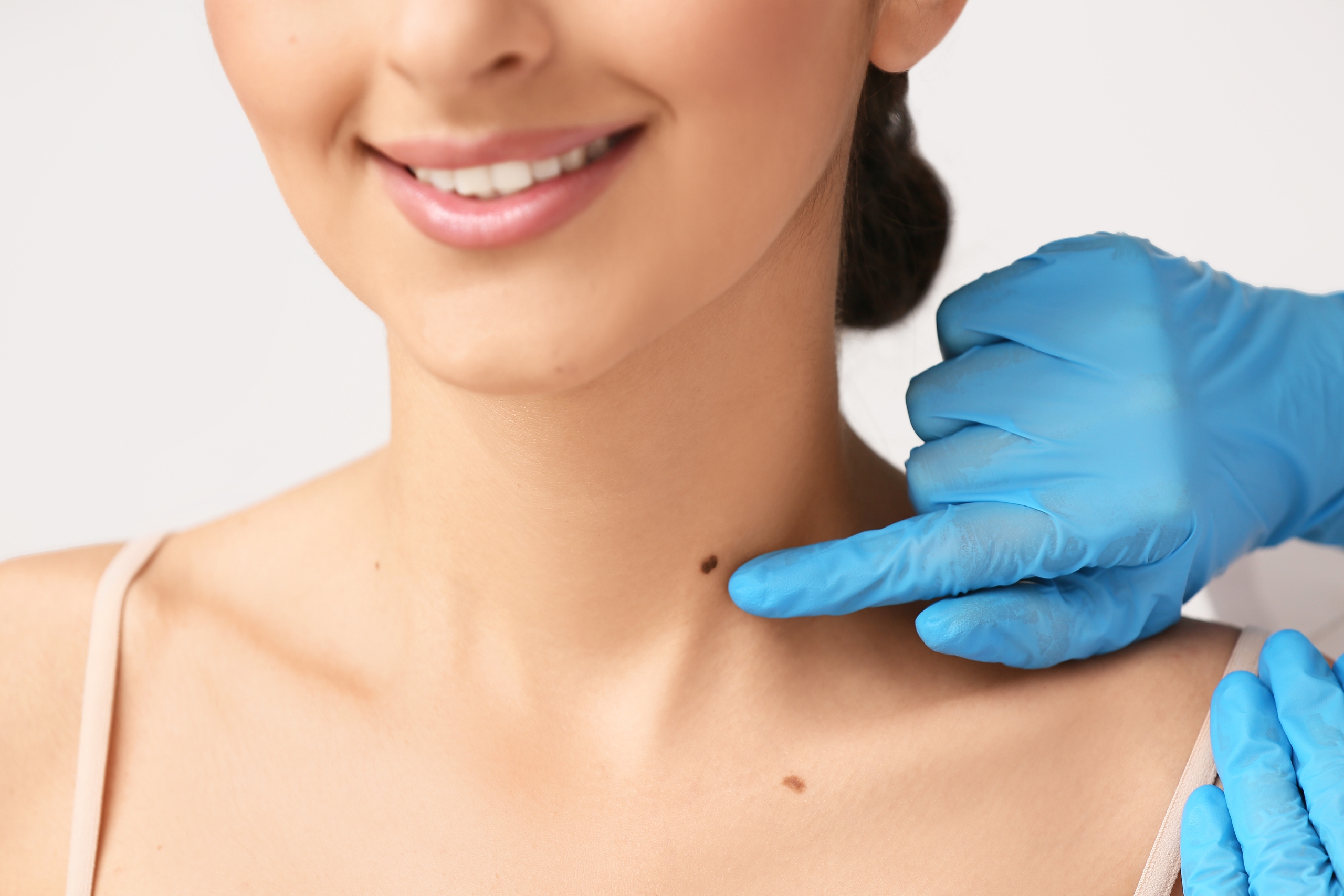 Mole Removal Procedures Explained Dermatologist Treatment Options and Essential Aftercare Tips